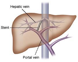 Treatment Transjugular intrahepatic portosystemic shunting (TIPS) is an invasive procedure used to manage refractory ascites or control refractory variceal bleeding.