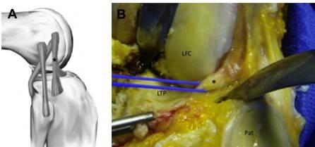Anterolateral Ligament Originates from the LFC, just anterior to the popliteus tendon Inserts on