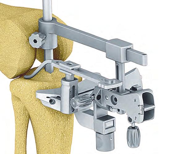 The 8mm diameter IM alignment rod (NQ475R or NQ473R) and IM rod adapter (NE320R) assembly is carefully introduced into the intramedullary tibial canal. (Fig.