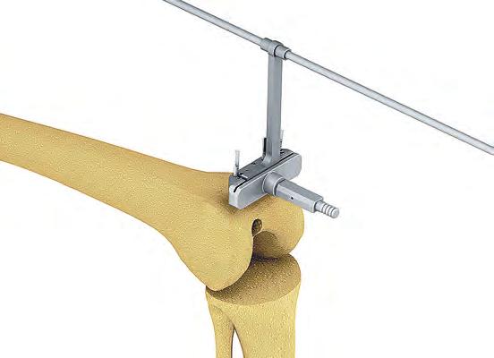 Checking the Mechanical Axis and Distal Femoral Cut Orientation (optional) Perpendicular alignment of the distal femoral cut to the mechanical axis of the limb can be confirmed by placing the