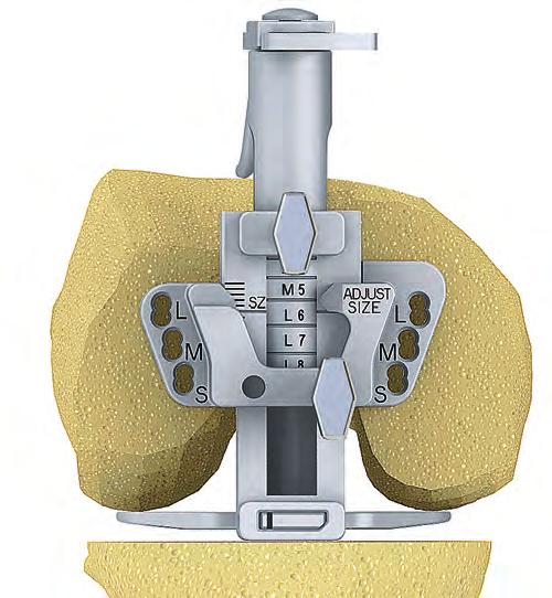 B A Setting the Orientation of the Femoral Component (4-in-1 cutting block orientation) The Adjust Size mechanism is locked using screw A so that the arrow N aligns with the femoral component size
