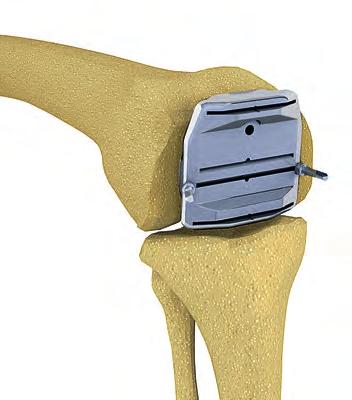 The guide is impacted until it is flush with the distal femoral resection. Two converging headed pins (NP586R) are used to prevent the block from lifting off the bone when performing the bone cuts.
