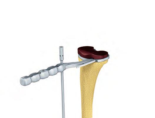 Gap Balancing Technique - Tibia First Checking the Tibial Resection