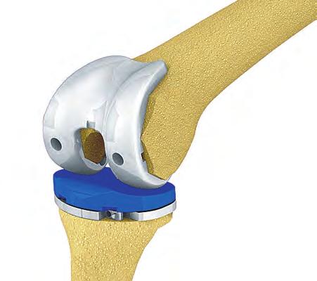 Gap Balancing Technique - Tibia First Trial Reduction The femoral trial component is attached to the resected femur and the correct size polyethylene trial is inserted into the joint space until the