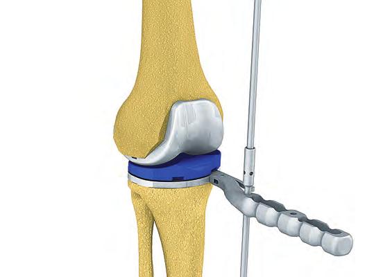 81) Alignment can be checked in flexion and extension by inserting the alignment rod assembly (NP471R & NE331R) thru the hole in the tibial plateau holder (NQ378R).