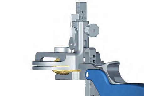 The clamp is set to the chosen resection thickness B and the resection is performed with the oscillating saw through the cutting slot in the halo portion of the device. (Fig. 91) Fig.