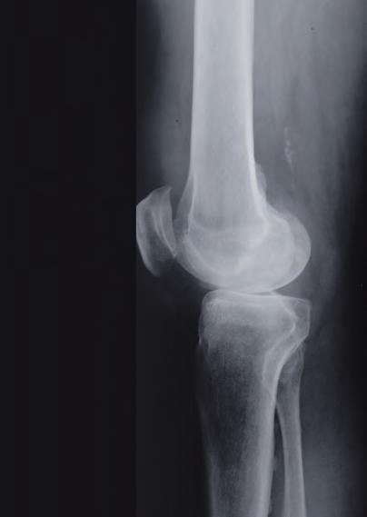F4R: NN034K cemented NN014K F4R: F3R: NN033K cemented NN013K F3R: STANDA Preoperative Planning The Columbus Knee System provides X-ray templates which help the surgeon to define the following