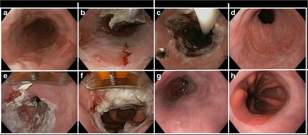 2 Esophagus (E Dellon, Section Editor) Introduction Radiofrequency ablation (RFA) has proven safe and effective for eradication of Barrett s esophagus (BE) with different grades of dysplasia.