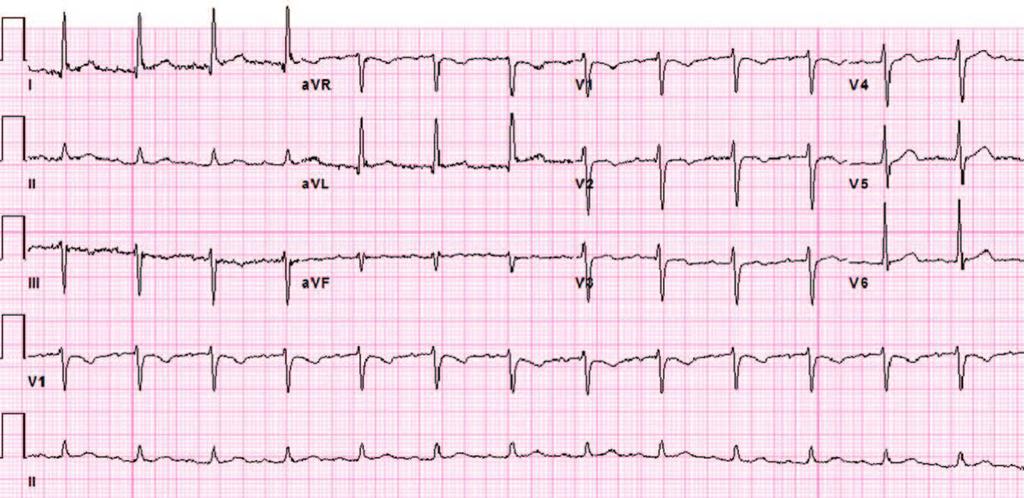 Shah et al Asymptomatic Severe Aortic Stenosis 1735 Figure 1. The 12-lead ECG showing left ventricular hypertrophy with nonspecific ST-T wave abnormalities.