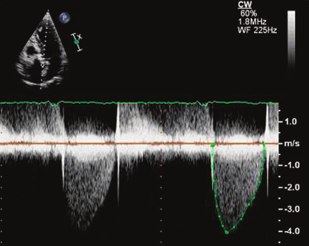 1736 Circulation October 26, 2010 Figure 3. Continuous-wave Doppler recording across the aortic valve in an apical 5-chamber view.