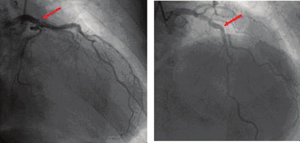 Shah et al Asymptomatic Severe Aortic Stenosis 1737 Figure 5. Right anterior oblique caudal (left) and cranial (right) views of the left coronary artery.