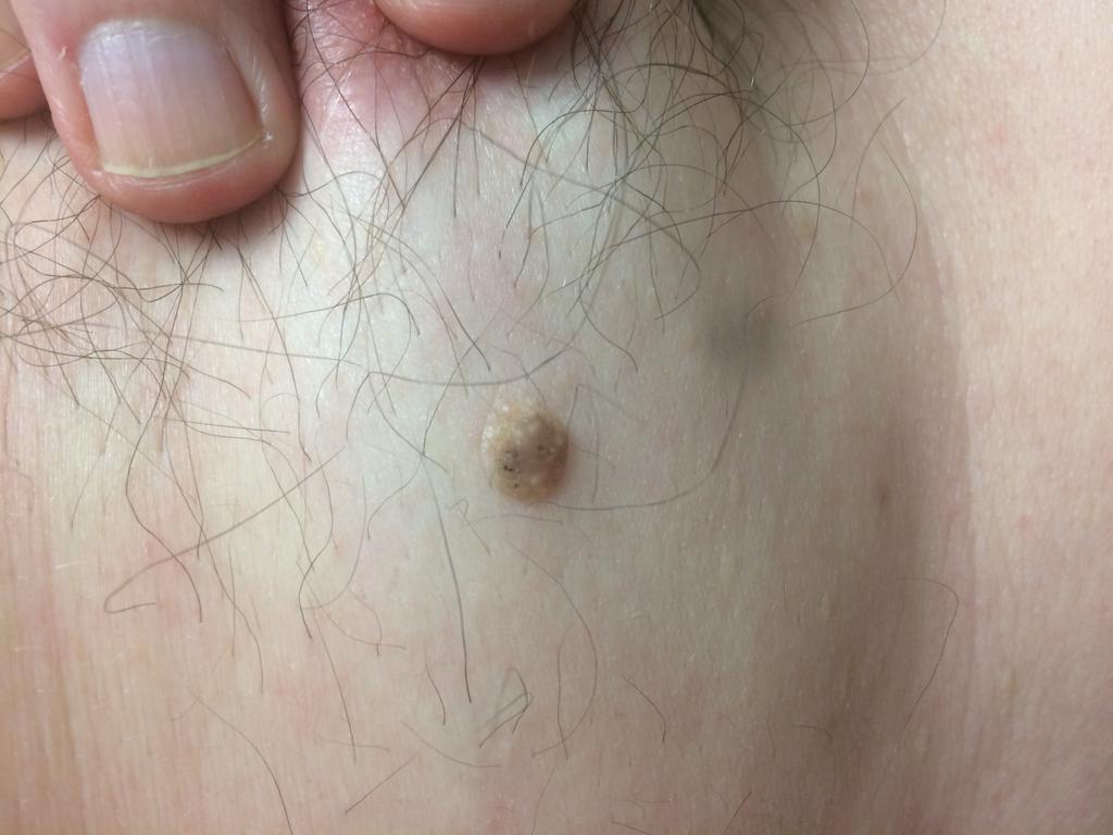 biopsy D/dx of a pigmented lesion?