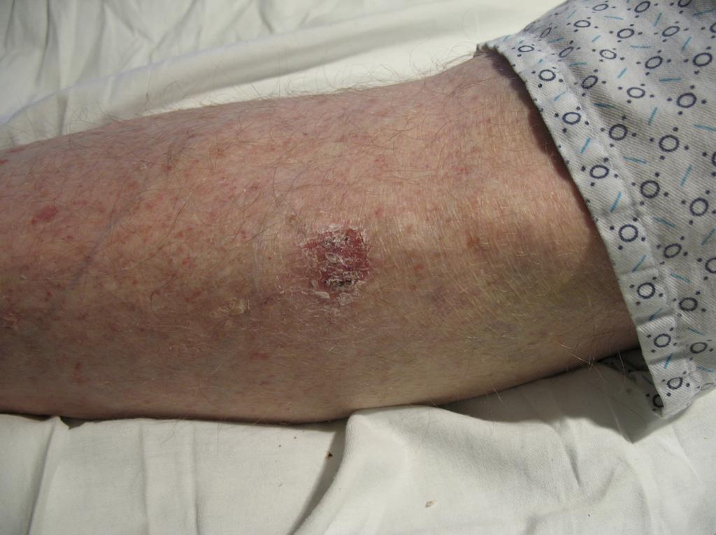 Squamous cell carcinoma SCC on sun-damaged skin