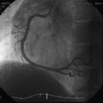 150 Fig. 1 Coronary angiograms and left ventriculogram Left: Right coronary artery was intact. Middle: Left coronary artery was intact.