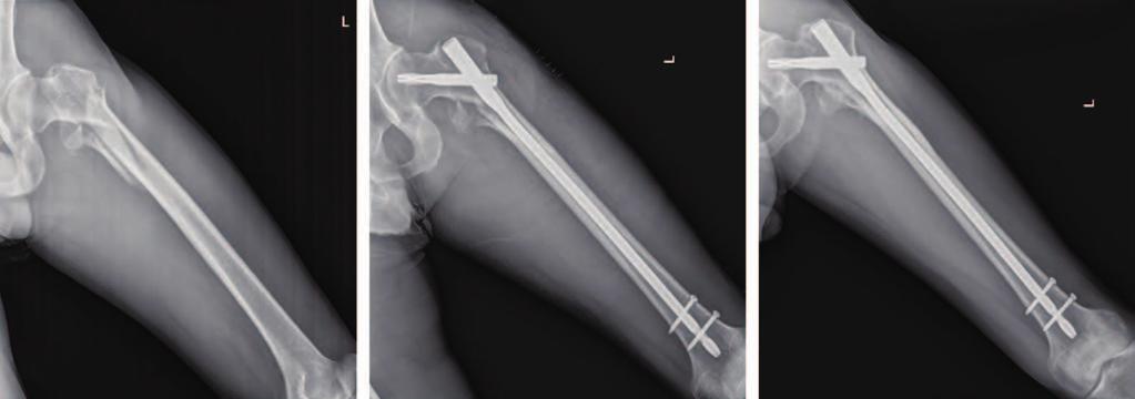 INTRODUCTION Subtrochanteric femoral fractures are commonly caused by high-energy injuries in young patients, low-energy injuries in osteoporotic patients 1), and rarely low-energy injuries in