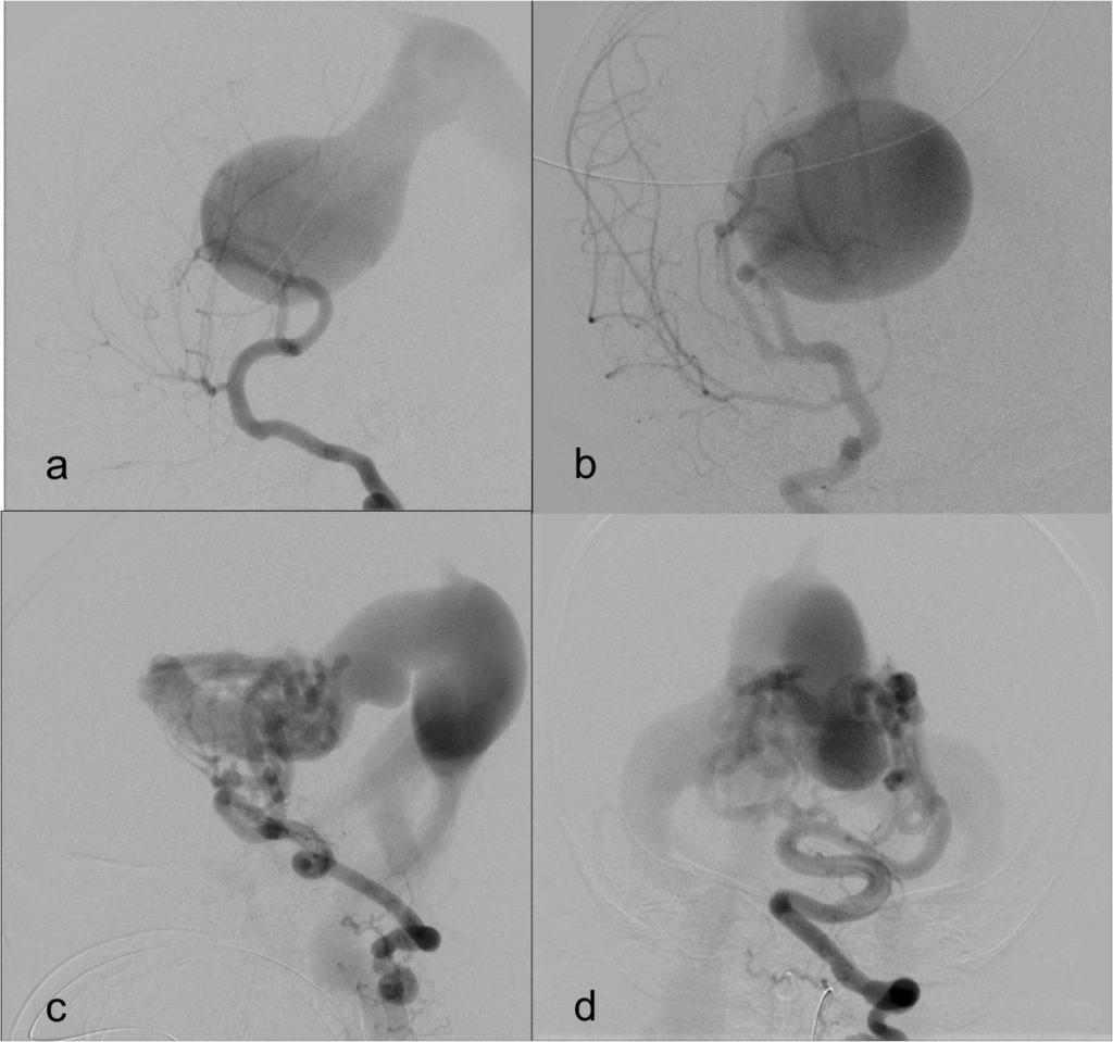Fig. 3: DSA: (a) Lateral and (b) frontal views of right internal carotid angiogram demonstrating mural type VGAM with individually identifiable hypertrophied feeding arteries.
