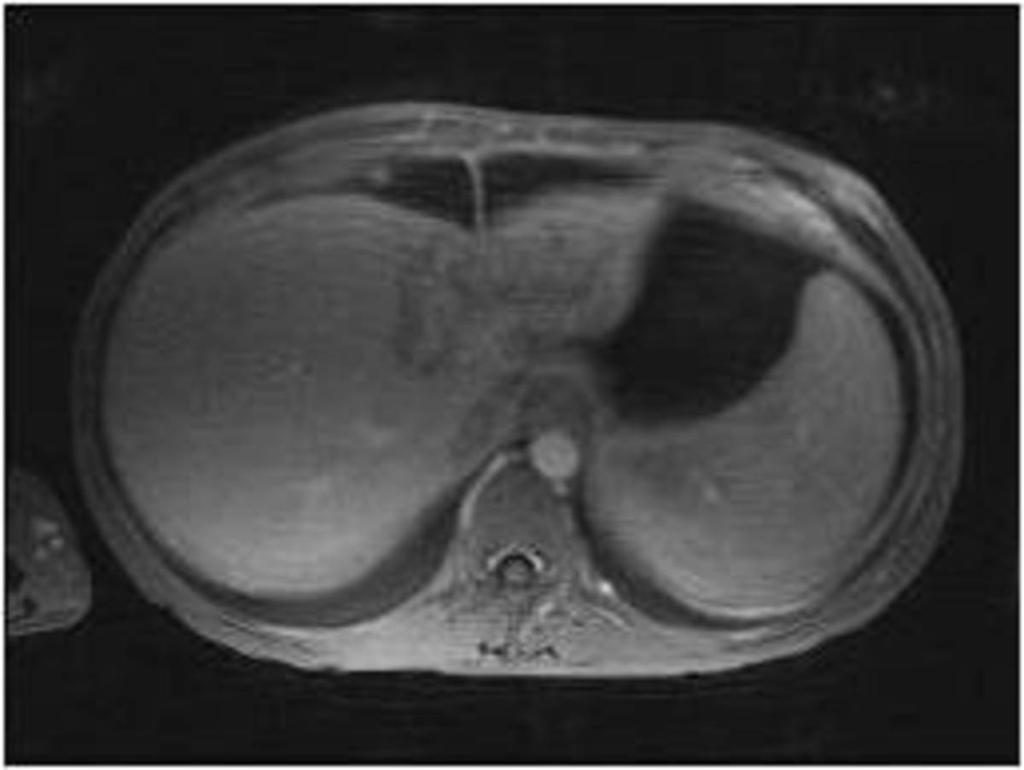 Fig. 8: Contrast enhanced T1 weighted image shows poorly enhancing lesion
