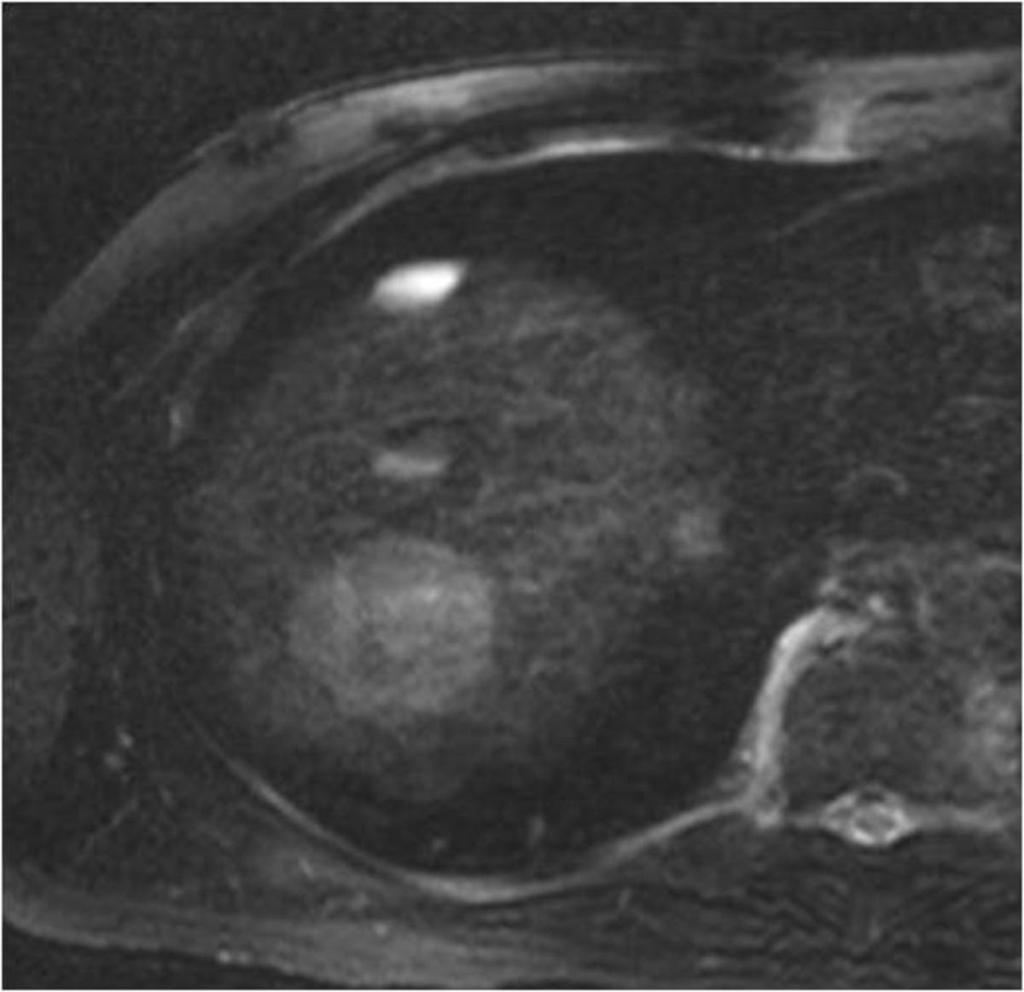 Fig. 2: T2FS weighted image demonstrates mass-forming