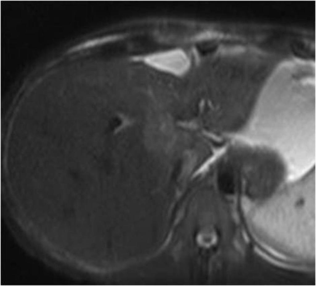 Fig. 7: T2HASTE weighted image demonstrating a moderately hyperintense