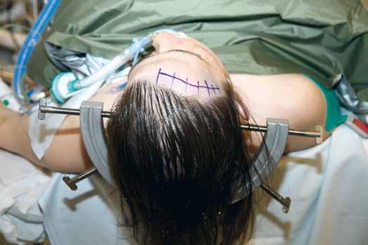 5.1.3. Incision and craniotomy The shaved area is minimal. An oblique frontotemporal skin incision is made behind the hairline (Figure 5-1a,b).