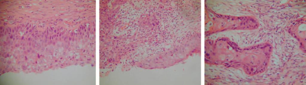 Squamous cell carcinoma in a dermoid cyst of the ovary Figure 2. Dysplastic squamous epithelium, squamous carcinoma arising from dysplasia and invasive squamous carcinoma.