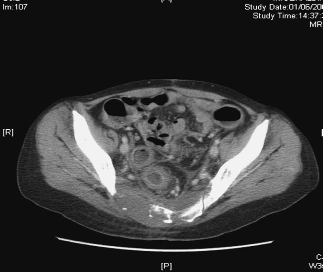 5 years since then. Case 7 relapsed 3 months after her initial surgery, and at this point, she had a sigmoid colectomy with incomplete debulking.