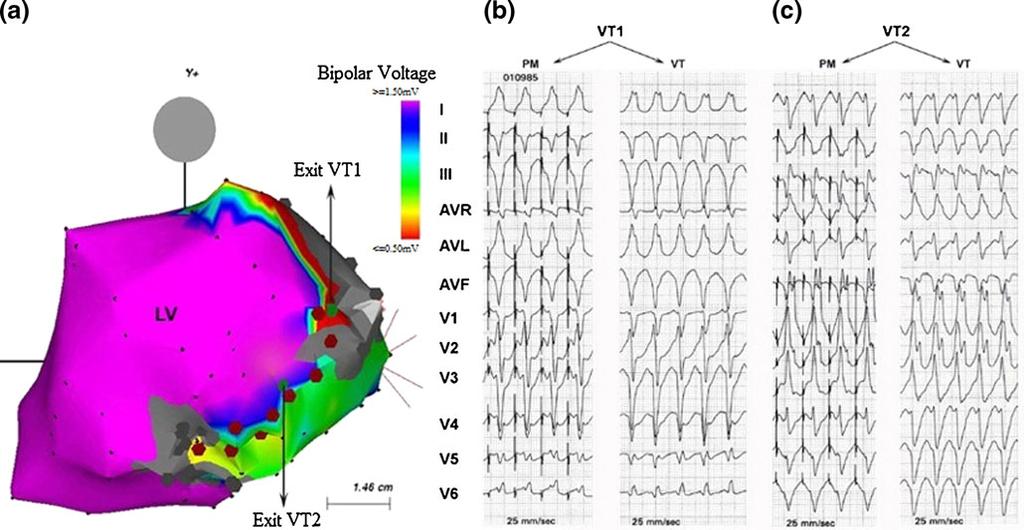 152 J Interv Card Electrophysiol (2011) 31:149 156 Fig. 1 (a) Voltage map during sinus rhythm of the left ventricle in a posterior anterior view in a patient with an inferoposterolateral infarction.