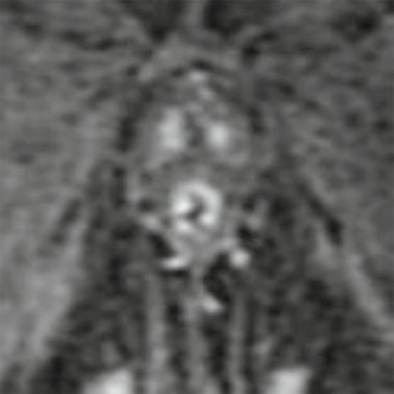 Zoomed in coronl T1-weighted imge fter intrvenous gdolinium-sed contrst dministrtion demonstrtes multiple smll enhncing mucosl nodules within the urethr (rrows) Fig.