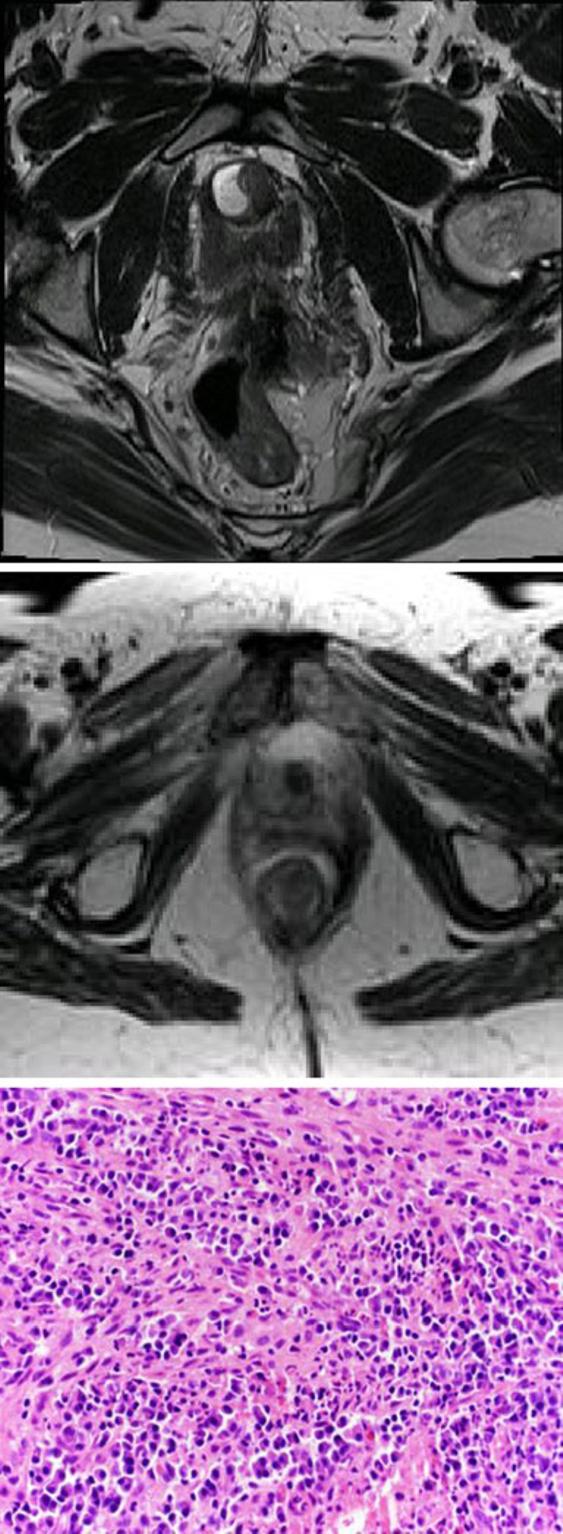 468 Insights Imging (2013) 4:461 469 c Fig. 12 Urethrl tumour mimics: urethrl ulking gents.