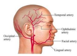 What is Giant Cell Arteritis?
