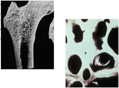 (Bad cells) Osteoporosis - A Silent Killer Osteoporosis Bone