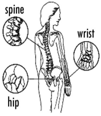 Hip Wrist Fracture Can Turn Your
