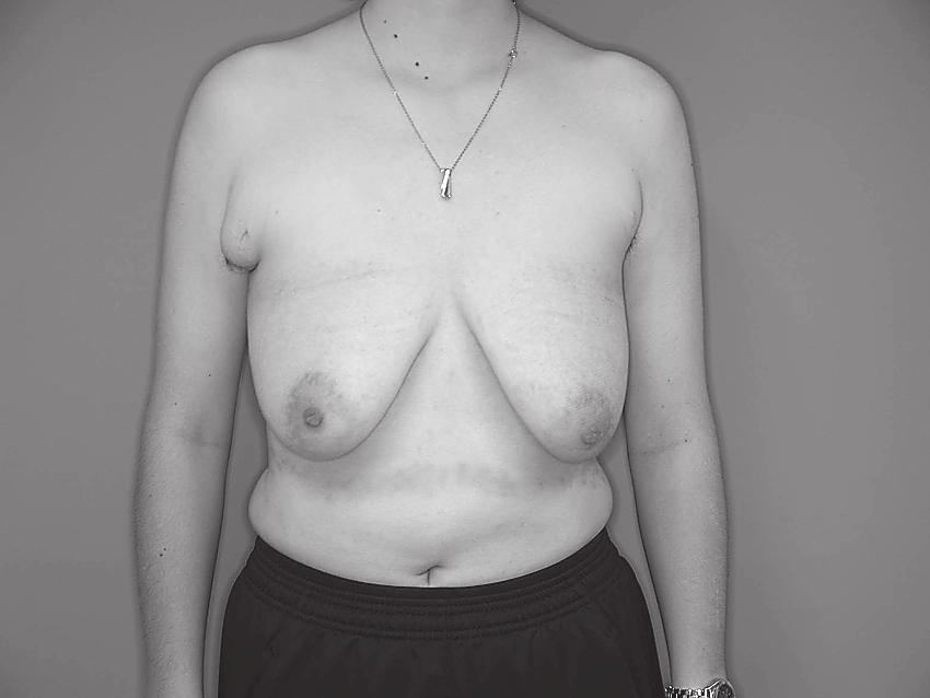 Namba et al.: Mastectomy in Female-to-male Transsexuals October 2009 Mastectomy in FTMTS Ａ Ｂ 247 Ｃ D E Fig.