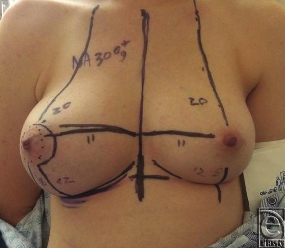 The nipple was inset, and the T incision was closed using absorbable interrupted dermal