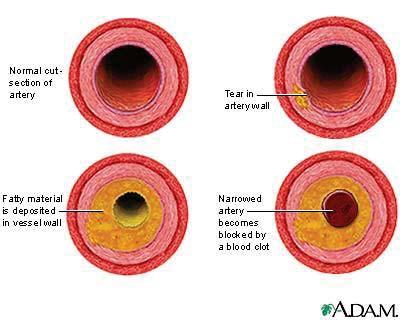 The development of arterial atherosclerosis may occur when deposits of