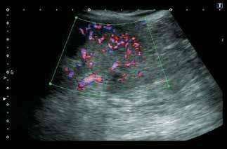 clearly delineated by using conventional color Doppler due to overpainting (Fig. 9a).