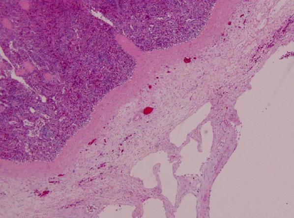 Variably sized multilocular cysts lined by thin attenuated endothelial cells and fibrotic stroma. Attached pancreas shows mild atrophy (H&E, 40). were found inside the cavity after the procedure.