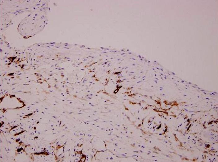 Bok-Kyung Sohn, et al. Fig. 6. Immunohistochemical stain. The lining endothelial cells show strong immunopositivity for CD31 and D2-40 and weak positivity for CD34 (Immunohistochemistry, 200).