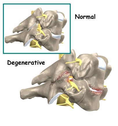 INTERVERTEBRAL DISC INJURIES The normal disc is perfectly formed and cushions the vertebrae above and below it The degenerative disc -