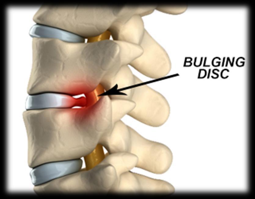 INVERTEBRAL DISC INJURIES The Bulging Disc may result when the disc moves out of its normal