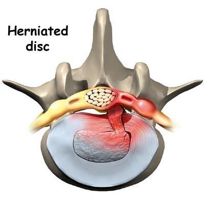 INTERVERTEBRAL DISC INJURIES The Herniated Disc similar to the bulging disc, but may result