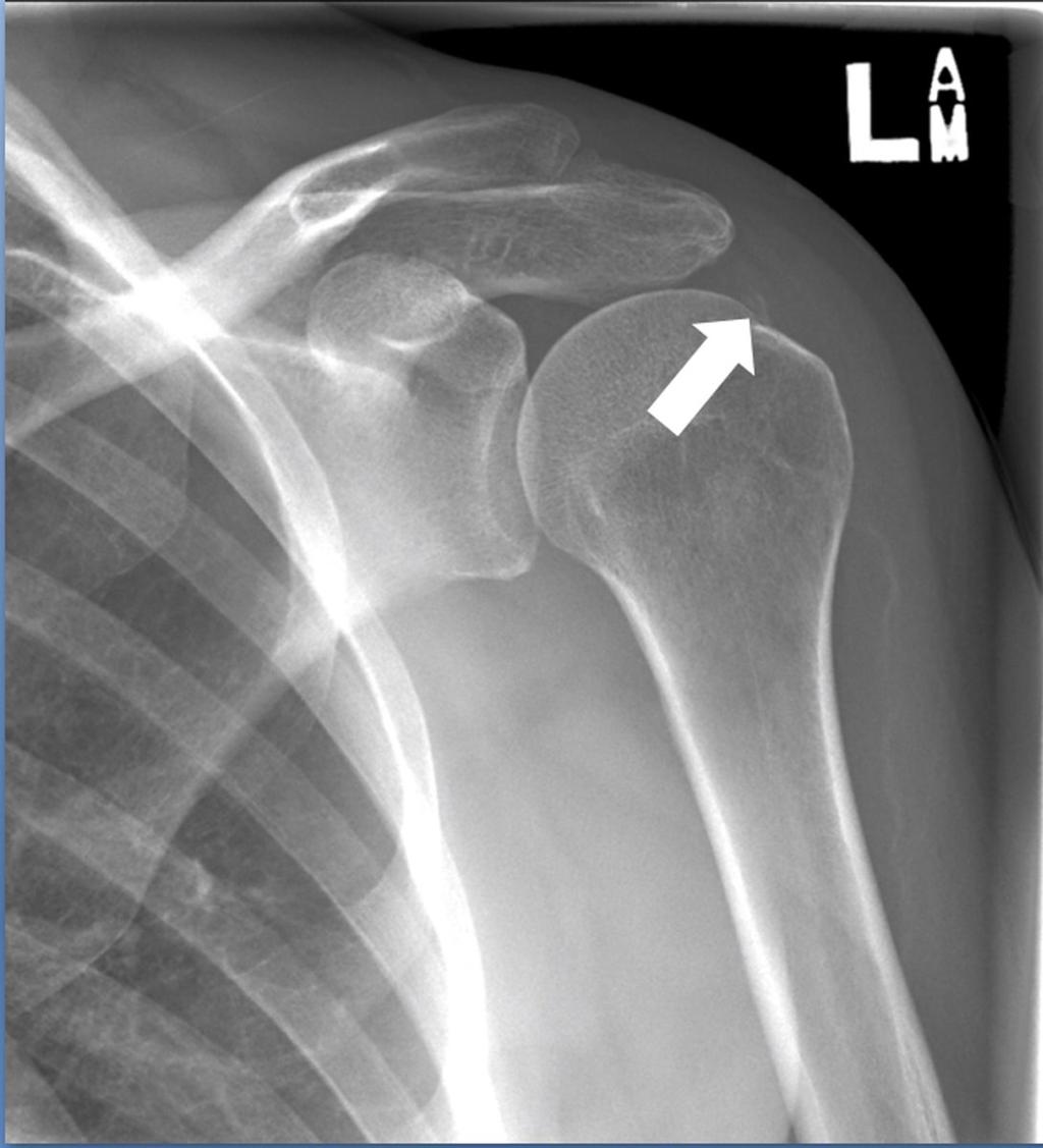 Fig. 0: 50-year old woman with a calcification of the supraspinatus and infraspinatus tendons. Radiograph at baseline reveals a large a sharply outlined, irregular calcification (arrow).