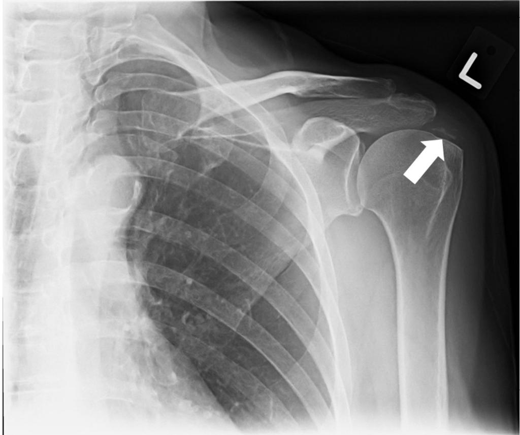 Fig. 0: 54-year old woman showing a calcific deposit at the level of the left supraspinatus tendon.