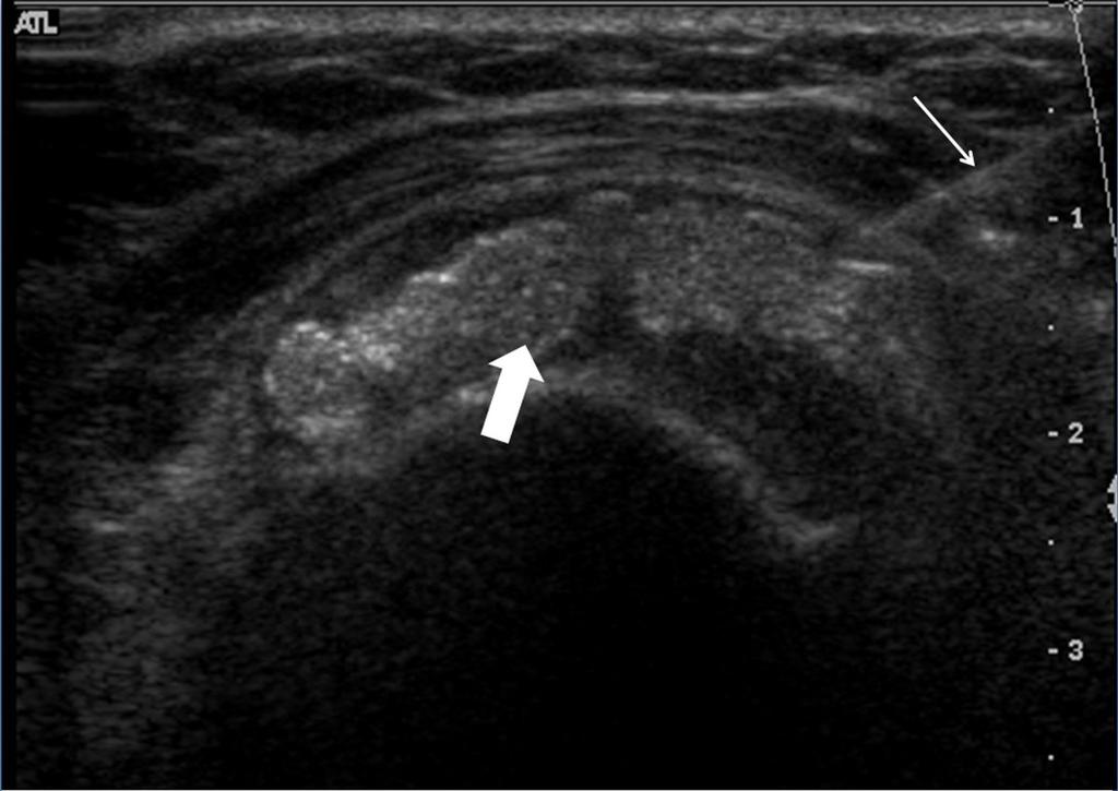 Fig. 0: 50-year old woman with a calcification of the supraspinatus and infraspinatus tendons. Radiograph at baseline reveals a large a sharply outlined, irregular calcification (arrow).