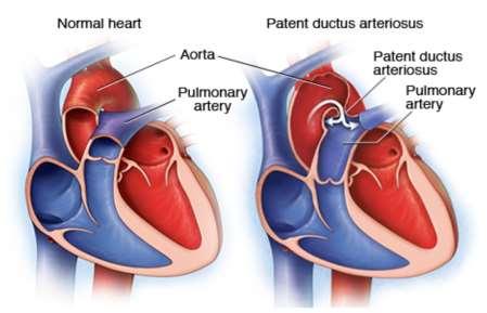 What is a PDA? The ductus arteriosus is a normal vessel in any mammalian foetus.