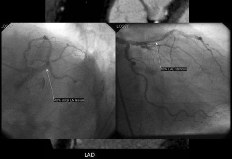 vs nonviable myocardium Evaluate for complications associated with infarction