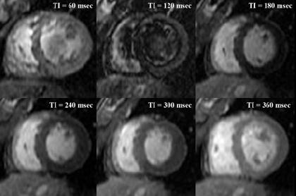 extensive capillary damage resulting in microvascular obstruction LATE PHASE replacement of infarcted myocardium by scar Delayed