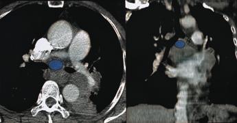 xial () and coronal () CT scans show subcarinal nodes (colored in teal blue), located inferior to tracheal carina between main bronchi. Fig. 10.
