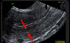 Question-mark sign of uterus - Sensitivity (75%) and