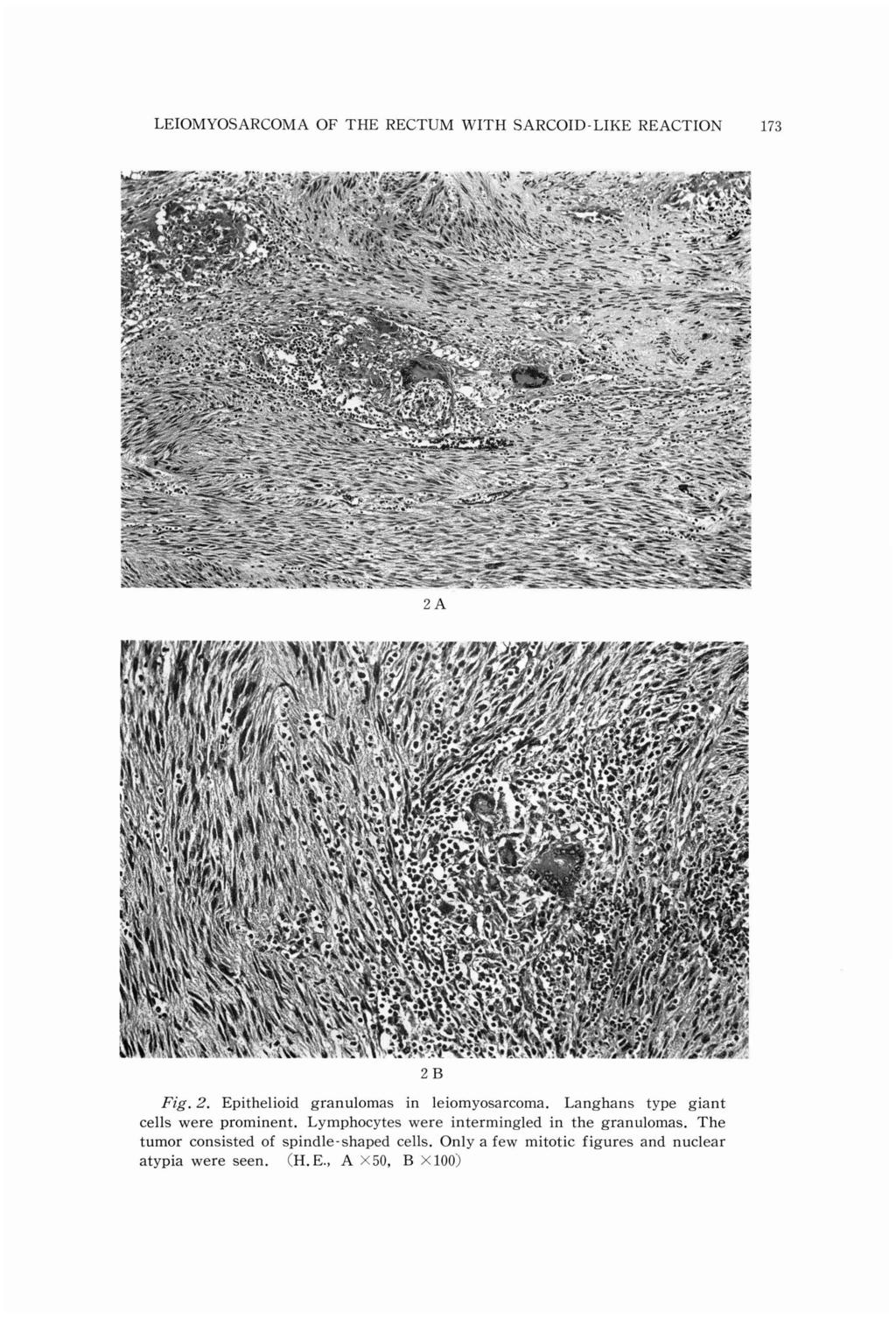 LEIOMYOSARCOMA Fig. cells 2. OF THE Epilioid granulomas proment. Lymphocytes tumor consisted atypia seen. spdle-shaped (H. E., RECTUM SARCOID-LIKE leiomyosarcoma.